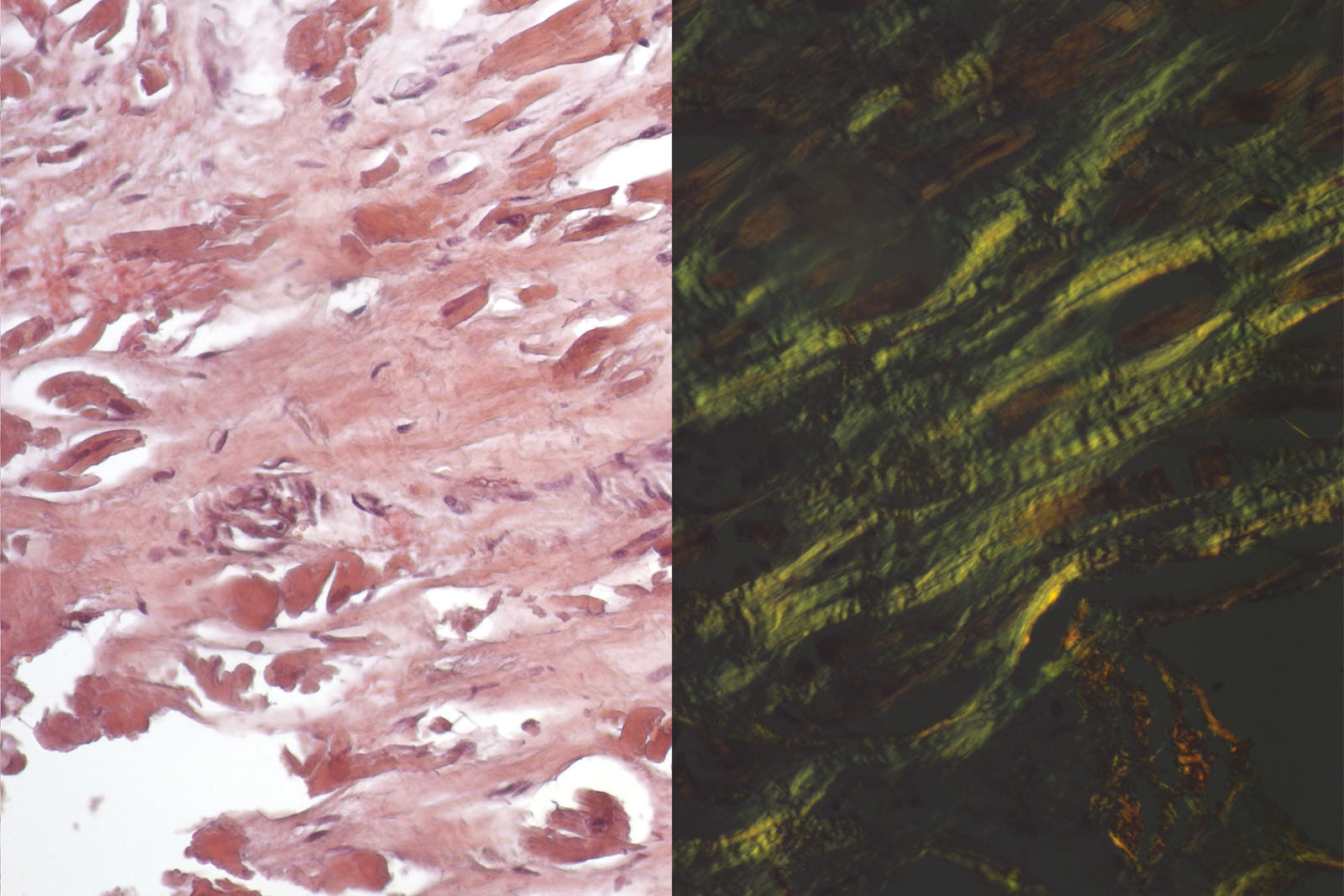 Congo Red Highman kit - staining Congo Red Highman kit - staining