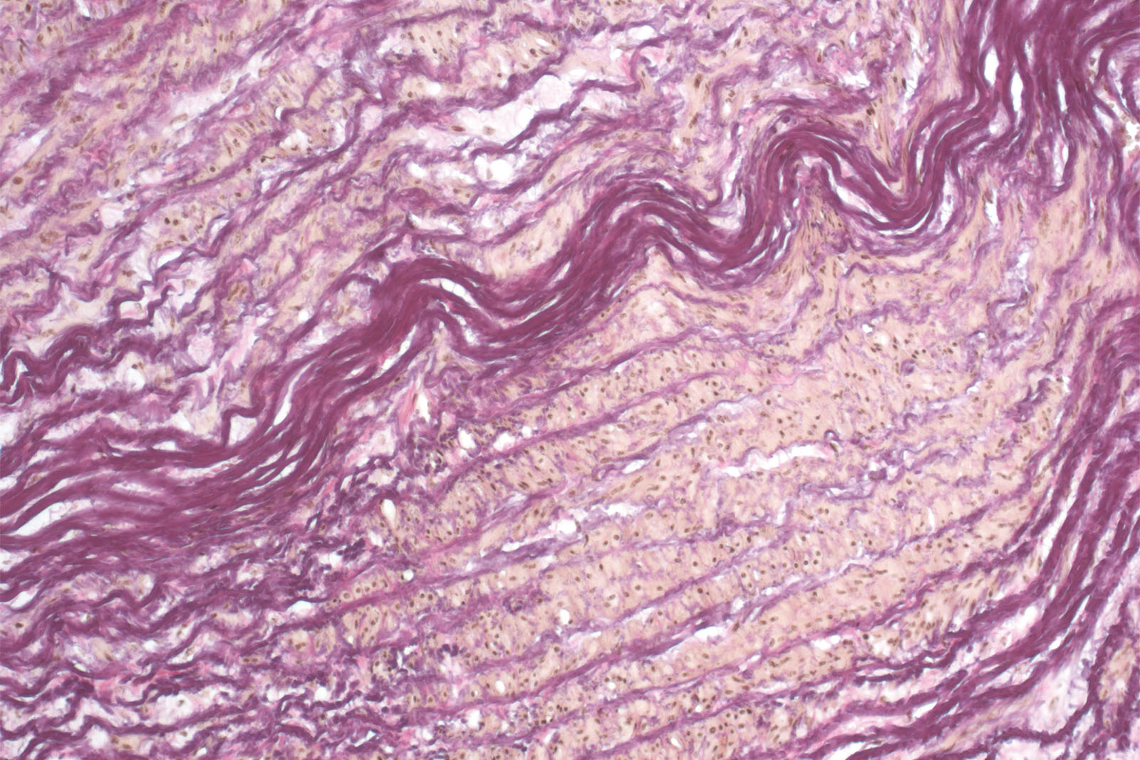 Weigert-Van Gieson kit - staining Weigert-Van Gieson kit - staining