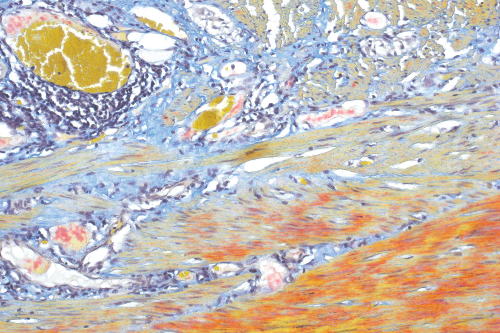 Martius Scarlet Blue (MSB) kit - staining Martius Scarlet Blue (MSB) kit - staining